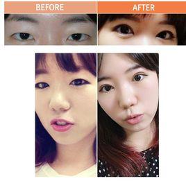 眼部吸脂 眼部吸脂