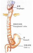 示意圖13:結腸-胃端側吻合