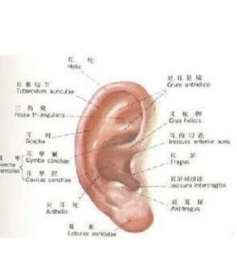 耳廓軟骨膜炎 耳廓軟骨膜炎