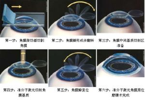 Visx S4準分子雷射手術步驟
