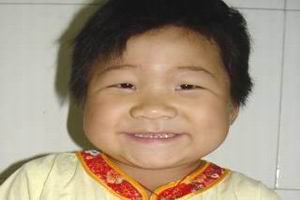 亞臨床型克汀病