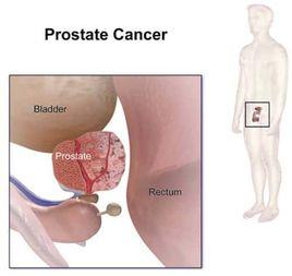 老年人前列腺癌 老年人前列腺癌