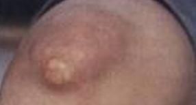 彈性假黃瘤 彈性假黃瘤