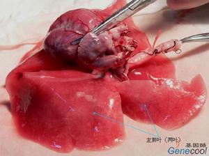 艾森曼格綜合症