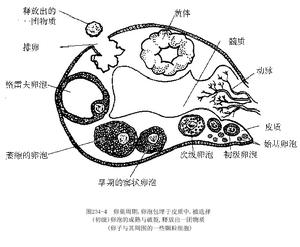 （圖）卵泡腺細胞增殖綜合徵