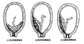 子宮頸內口 子宮頸內口