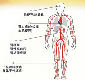 高脂血症 高脂血症