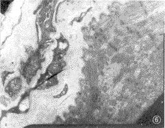（圖）多發性肌炎