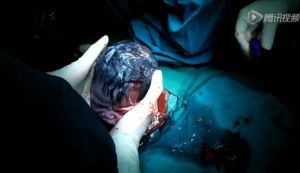 剖腹產視頻 剖腹產視頻