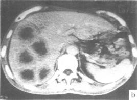 肝轉移癌 肝轉移癌
