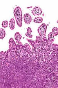 非霍奇金病 非霍奇金病