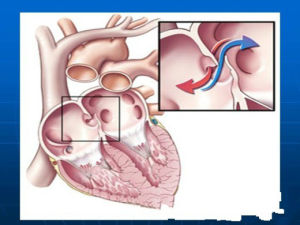 左心室高電壓 左心室高電壓