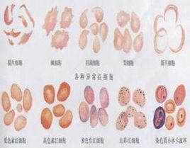 紅細胞沉降 紅細胞沉降