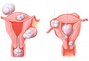 子宮肌腺症 子宮肌腺症