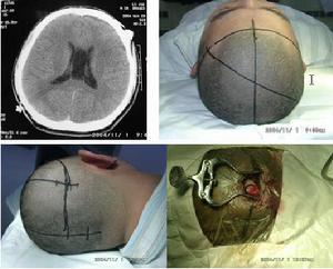 胼胝體進行性變性