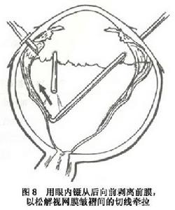 增生性玻璃體視網膜病變