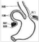 食管裂孔疝修補術