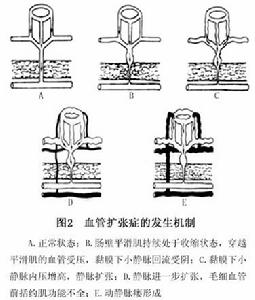 結腸血管擴張症