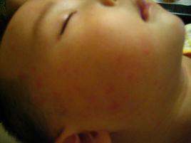 小兒急疹 小兒急疹
