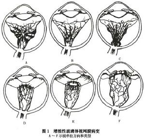增生性玻璃體視網膜病變