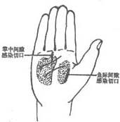 急性化膿性腱鞘炎 急性化膿性腱鞘炎