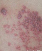 耳帶狀皰疹 耳帶狀皰疹