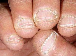 指甲呈扁平形 指甲呈扁平形