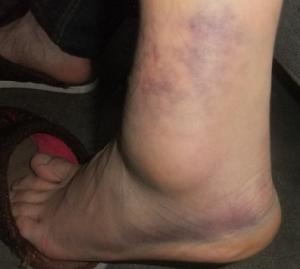 筋骨扭傷 筋骨扭傷