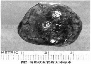 眶內海綿狀血管瘤