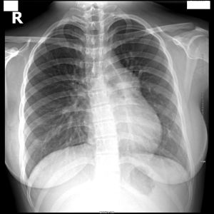 原發性肺動脈高壓