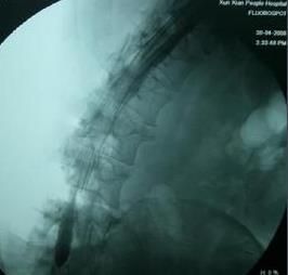 腰椎椎管狹窄症