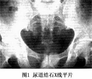 尿道結石X光平線