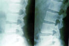 （圖）脊柱彎曲