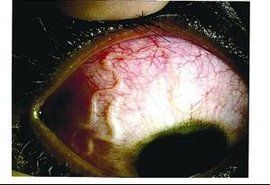 眼睛寄生蟲 眼睛寄生蟲