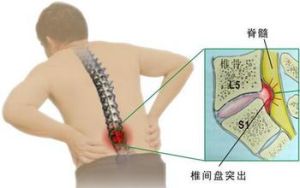 腰椎間盤突出症