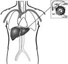 肝豆狀核硬化 肝豆狀核硬化