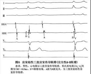 完全性房室傳導阻滯