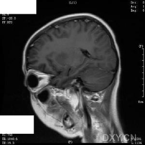 小兒病毒性腦炎