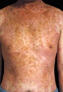 尋常型天皰瘡 尋常型天皰瘡