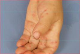 皰疹性咽頰炎 皰疹性咽頰炎