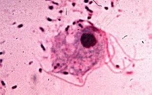 陰道毛滴蟲病 陰道毛滴蟲病