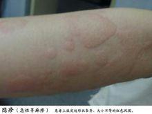 藥物導致的過敏