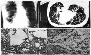 淋巴管平滑肌瘤