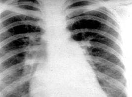 肺含水量增加 肺含水量增加