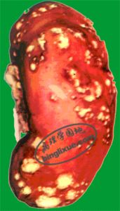 圖9腎多發性膿腫多發散在黃白色膿腫灶