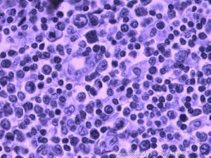 小兒霍奇金病 小兒霍奇金病