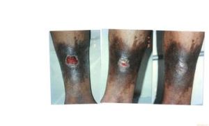 下肢脈管炎 下肢脈管炎