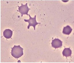 棘細胞：紅細胞表面有針尖狀突起，其間距不規則，突起的長度和寬度可不一。增多見於β-脂蛋白（LDL）缺乏症。
