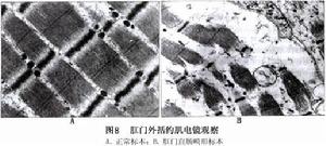 先天性肛門直腸畸形