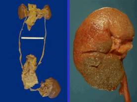 老年人慢性腎盂腎炎